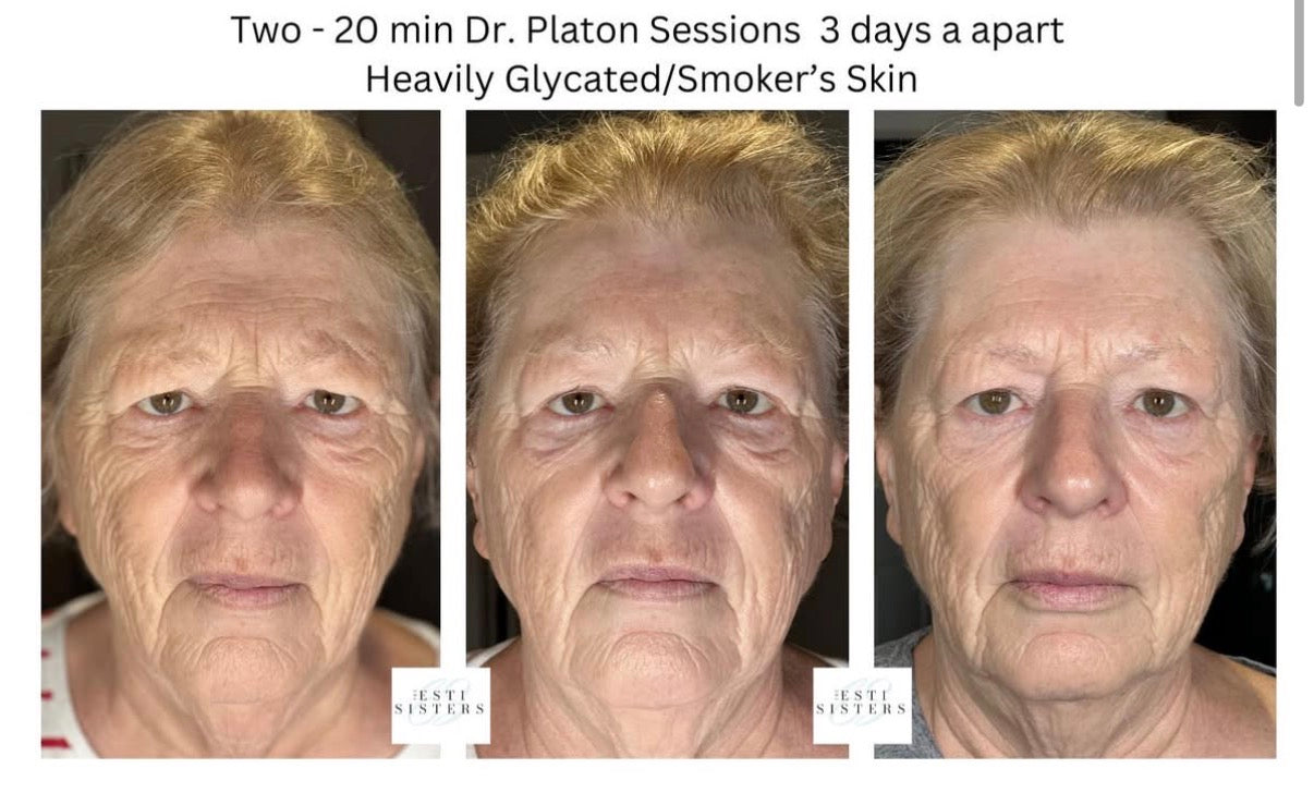 Cold Plasma Session